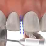IPRとは？歯と歯の間のエナメル質を少し削ってスペースを作ります、その目的と注意点